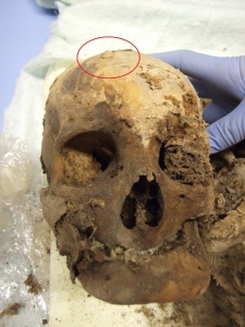 Il cerchietto rosso evidenzia il tumore benigno nel cranio